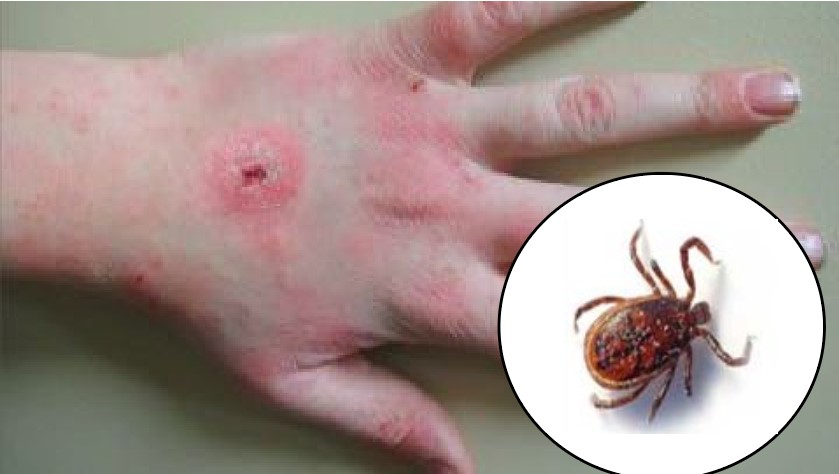 Scrub Typhus Spreads to 74 Districts, More Than 10,000 Infected